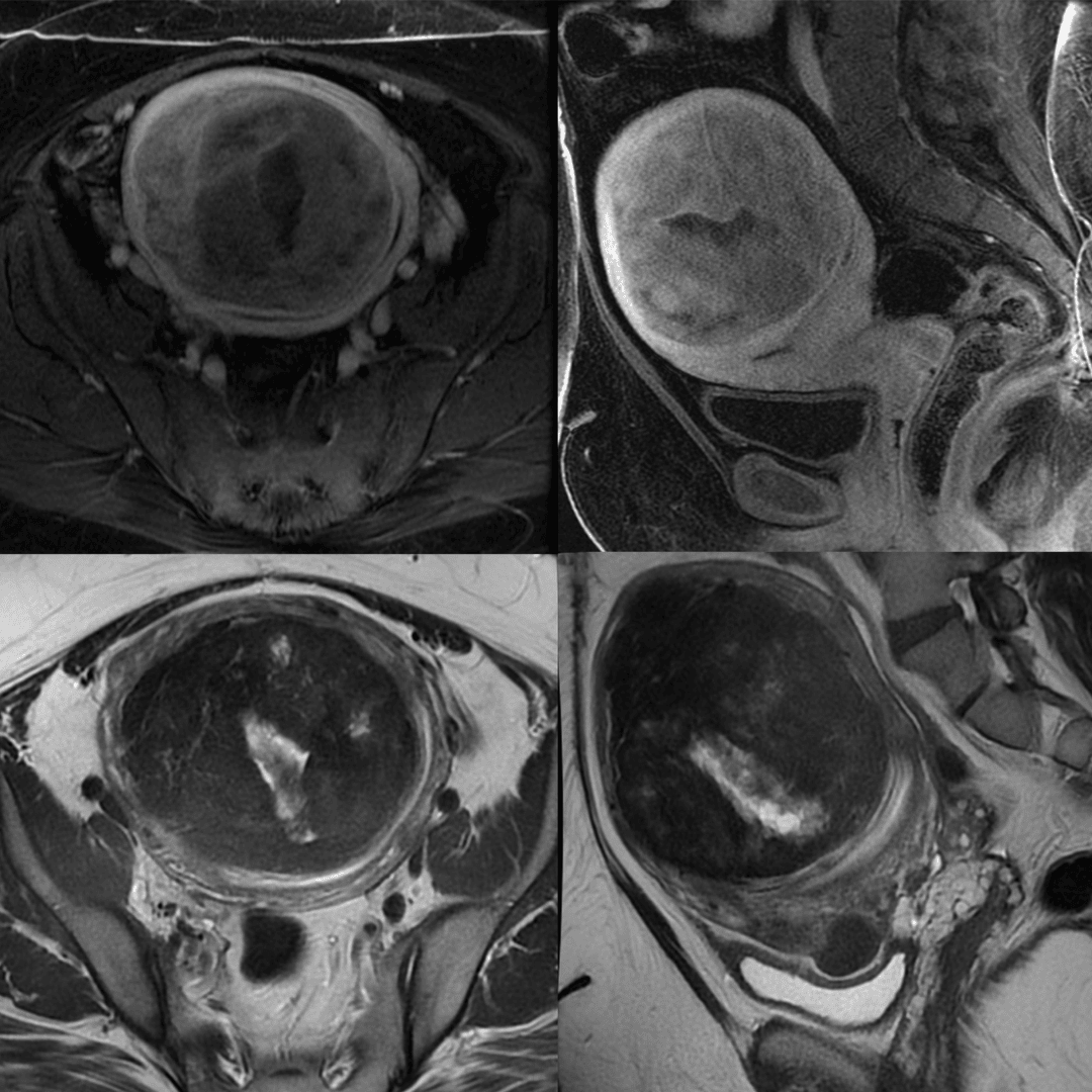 Fibroids and Pregnancy: Essential Guide for Expectant Mothers 3 Imagerie par résonance magnétique d'une femme avec des fibromes utérins / Magnetic Resonance Images of Woman with Uterine Fibroids